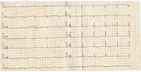 Communicating Concerns About Nonspecific Changes on ECG.